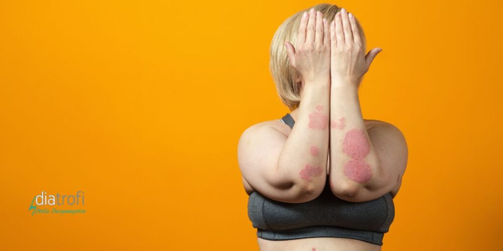 Ψωρίαση και διατροφή